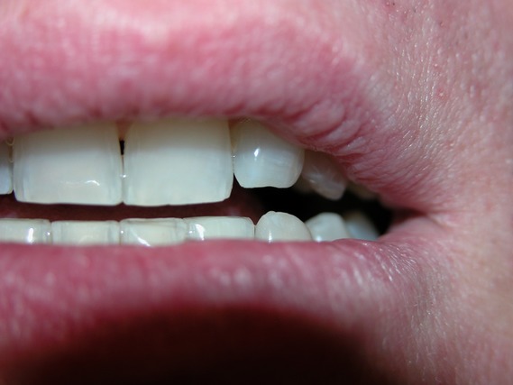 http://a.imdoc.fr/1/sante-forme/dentition/photo/0048844004/21864236ed4/dentition-2013-lingual-face-img.jpg